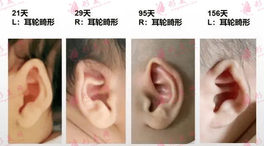小耳畸形矯正適應(yīng)年齡 小耳畸形矯正適應(yīng)年齡