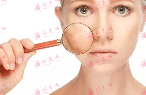 毛孔粗大 毛孔粗大
