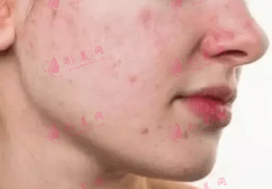 青春痘 青春痘