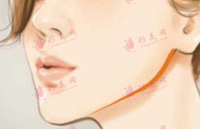 去頰脂墊 去頰脂墊