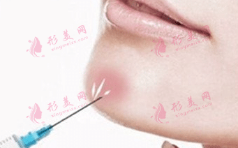 玻尿酸填充下巴 玻尿酸填充下巴