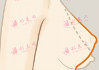 乳房下垂矯正 乳房下垂矯正