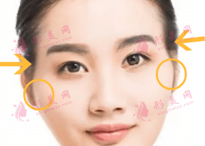 顴骨改善