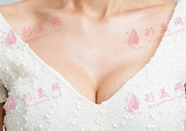 自體脂肪填充胸部 自體脂肪填充胸部