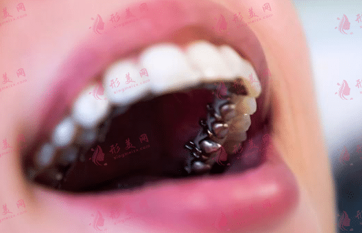 舌側(cè)矯正