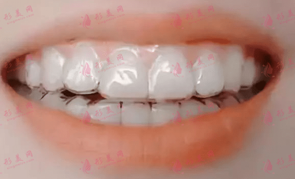 隱形牙套