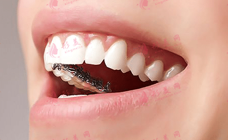 舌側(cè)矯正 舌側(cè)矯正