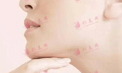 雙下巴 雙下巴