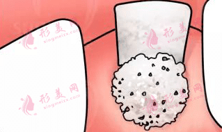 種植牙骨粉