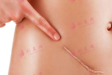 激光去疤痕手術(shù)的原理、維持時(shí)間、術(shù)后護(hù)理