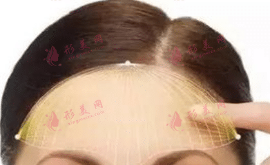 玻尿酸豐額頭