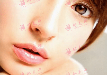 鼻翼縮小