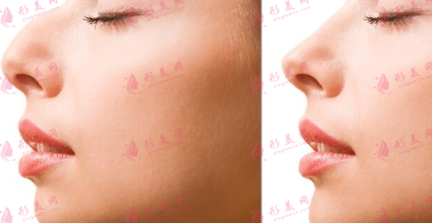駝峰鼻矯正前后對比 駝峰鼻矯正前后對比