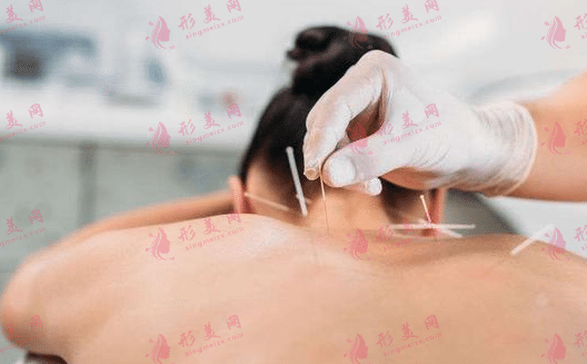 針灸減肥 針灸減肥