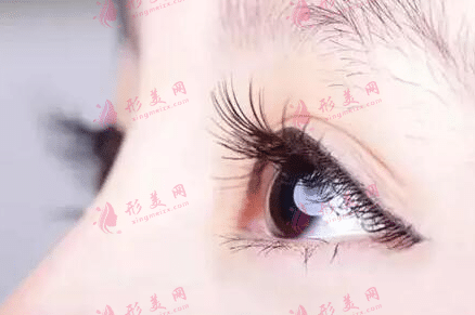 眼皮吸脂 眼皮吸脂