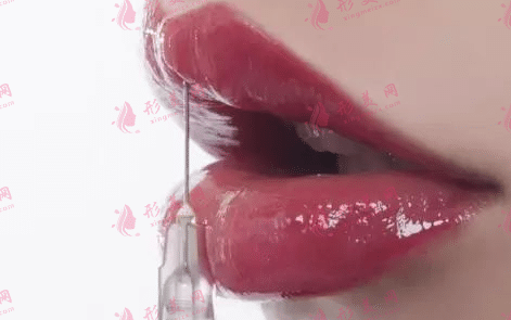 玻尿酸豐唇 玻尿酸豐唇