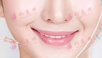 瘦臉針 瘦臉針