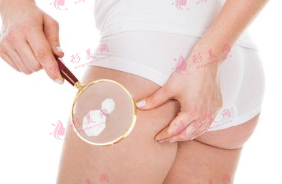 大腿吸脂 大腿吸脂