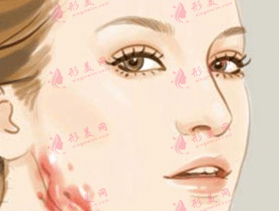 激光祛疤 激光祛疤