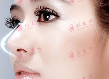鼻翼縮小 鼻翼縮小