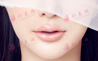 玻尿酸填充法令紋 玻尿酸填充法令紋