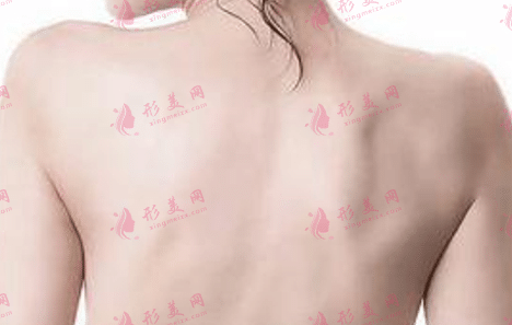 背部吸脂 背部吸脂
