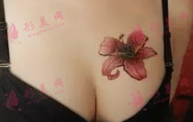 乳暈縮小