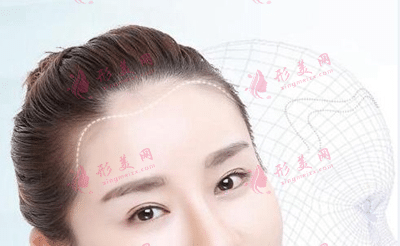深圳科發(fā)源發(fā)際線種植好不好 深圳科發(fā)源發(fā)際線種植好不好