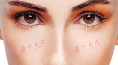 開眼角 開眼角