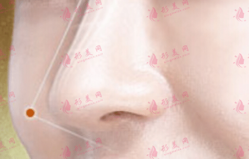 鼻頭縮小手術(shù)