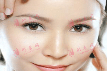 自體脂肪填充太陽(yáng)穴 自體脂肪填充太陽(yáng)穴
