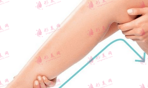 小腿吸脂 小腿吸脂