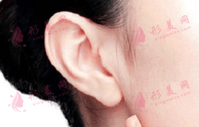 自體脂肪豐耳垂 自體脂肪豐耳垂