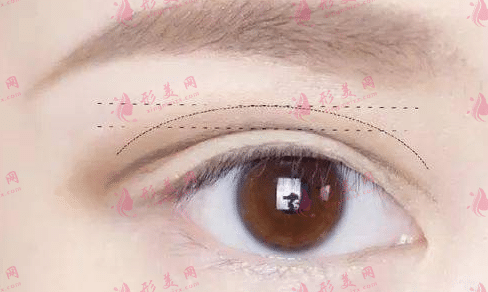 割雙眼皮之后眼角增生了怎么辦？激光祛疤效果如何？