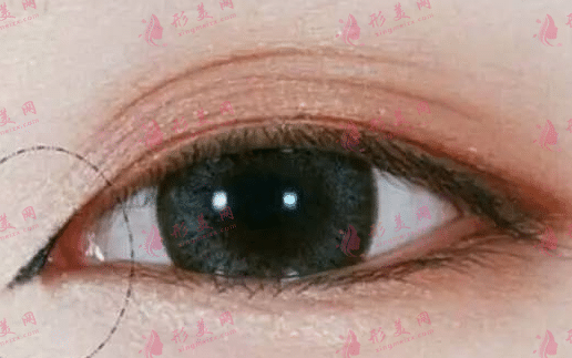 開眼角 開眼角