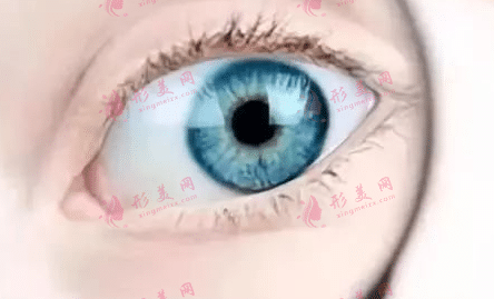 正常雙眼皮 正常雙眼皮