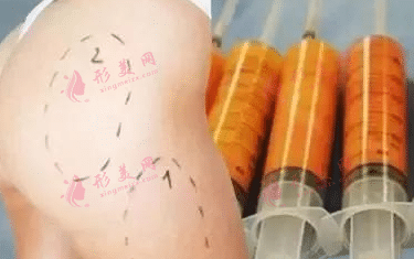 自體脂肪移植 自體脂肪移植