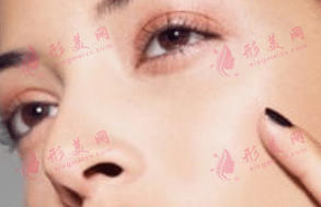 鼻頭縮小 鼻頭縮小