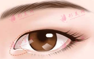 開眼角 開眼角
