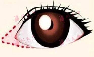 開(kāi)眼角