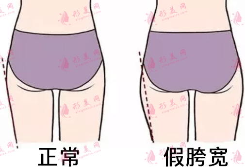 假胯寬 假胯寬