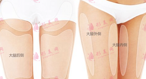 吸脂 吸脂