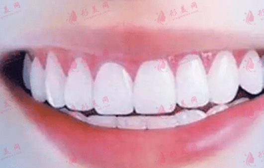 冷光牙齒美白 冷光牙齒美白