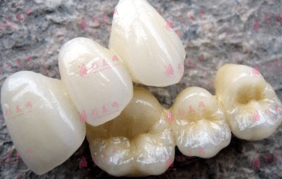 烤瓷牙 烤瓷牙