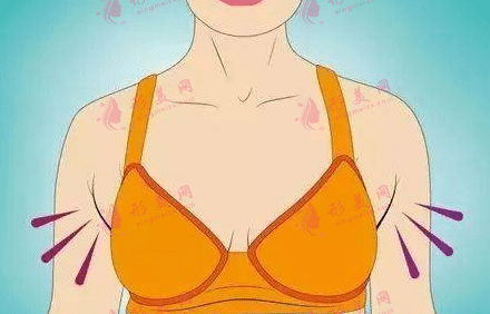 吸脂去副乳 吸脂去副乳