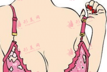 吸脂去副乳 吸脂去副乳