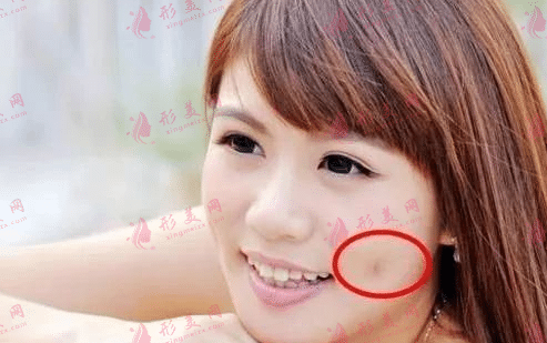 人造酒窩 人造酒窩