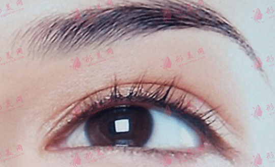 針對(duì)眼皮松弛是提眉好還是切眉好？