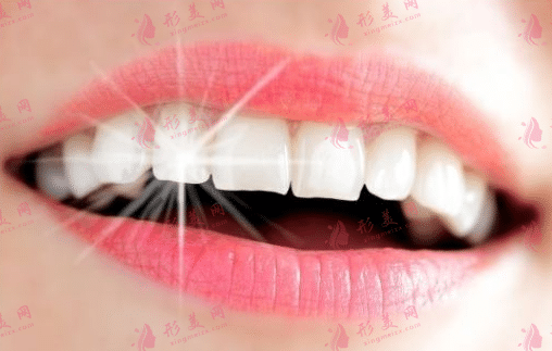 牙齒美白 牙齒美白