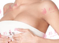 乳房提升 乳房提升